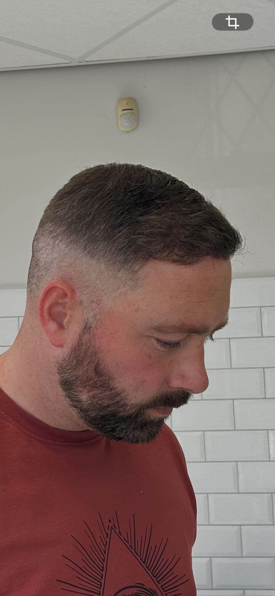 Temple and hairline restoration — progress view